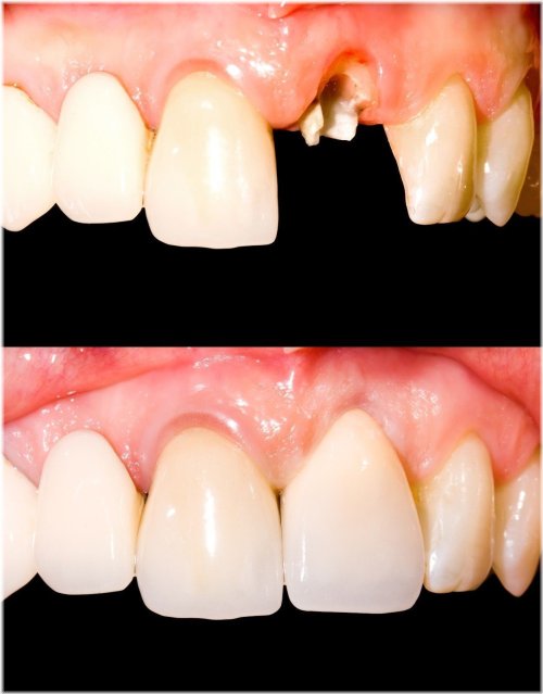 QuickFix Tooth Replacement Set